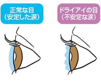 ドライアイとは